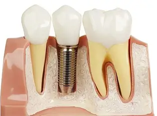 Dental Implants Overview